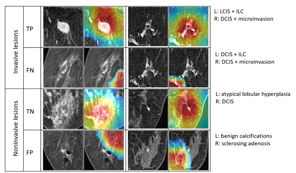 Thumbnail for Detecting invasive breast carcinoma on dynamic contrast-enhanced MRI