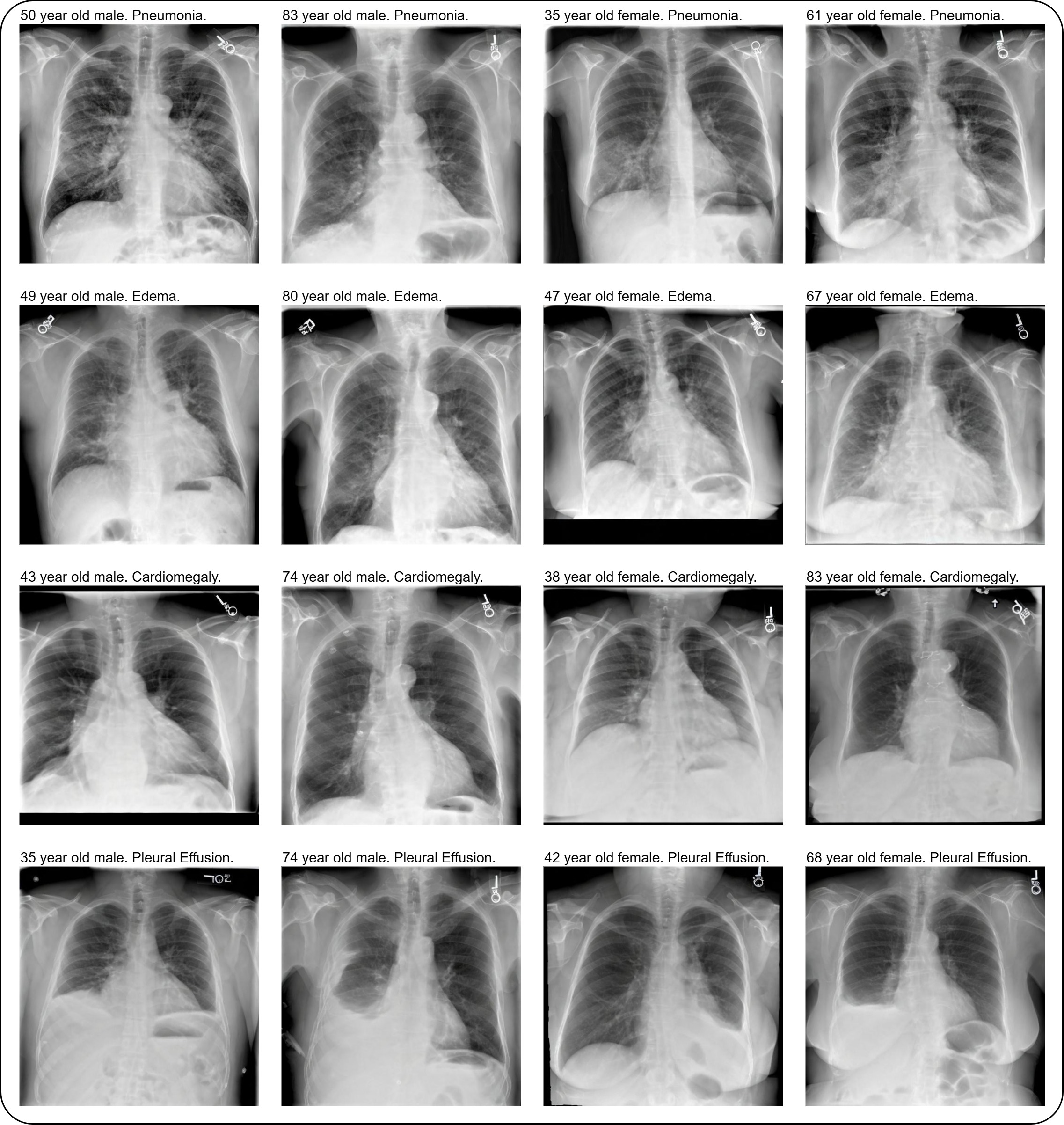 Thumbnail for Improving Performance, Robustness, and Fairness of Radiographic AI Models with Finely-Controllable Synthetic Data